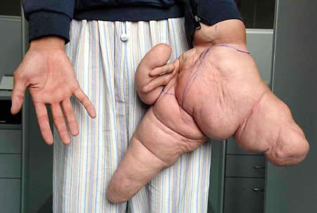 Lui Hua World's Largest Hand his left thumb is 10.2 inches long